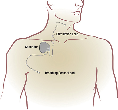 Electrical Stimulation Gainesville and Newberry, FL - ReQuest