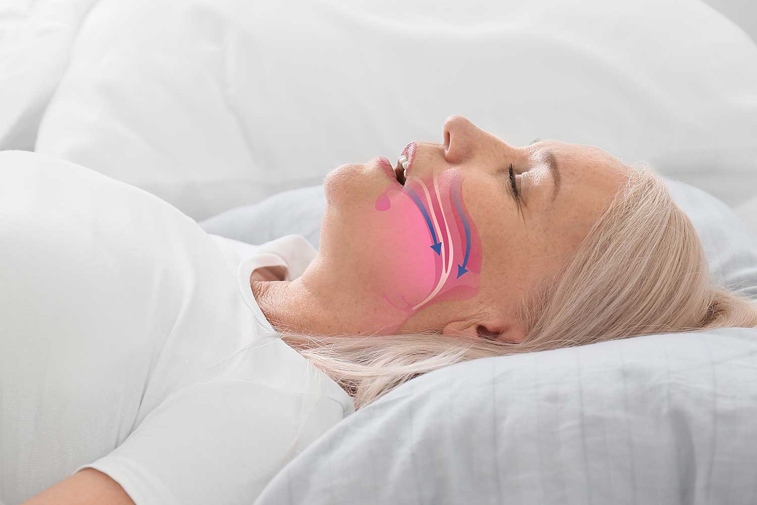 What is Positional Obstructive Sleep Apnea by Accent Sleep Solutions